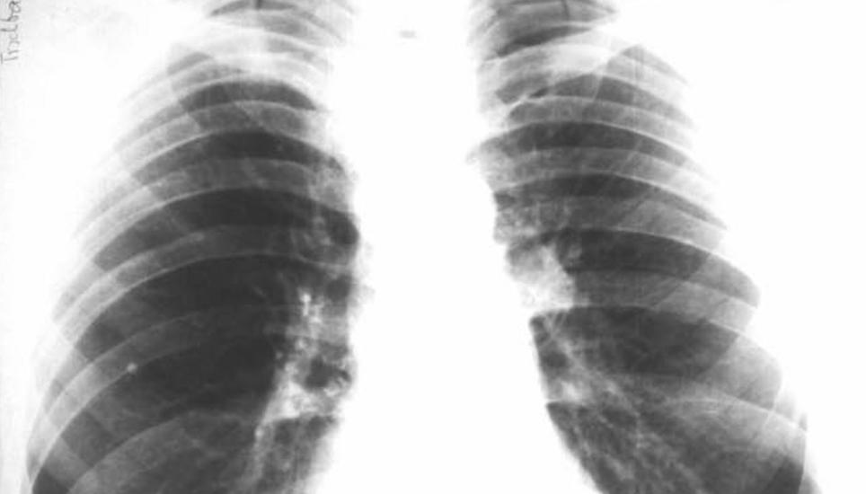 Trotzdem machte die Medizin immer weiter Fortschritte: Röntgenbilder waren damals schon weit verbreitet, wenngleich sie um einiges schädlicher waren als heute. Forscher fanden heraus: Die Strahlung damals war ungefähr 1200-mal so hoch wie sie moderne Geräte aufweisen.