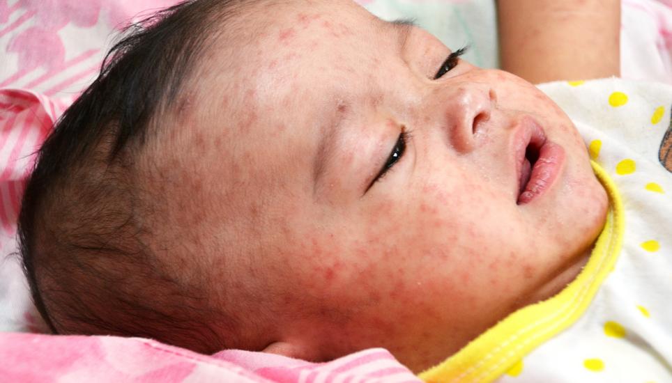 Measles. Close-up of a baby with a rash on its face caused by measles. Measles is a highly contagious respiratory disease caused by the measles virus (MeV). It typically causes an itchy rash and fever. It mainly affects children, but one attack usually gi